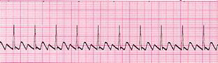 Illustration of a regular, rapid atrial flutter rhythm compared with a normal heartbeat