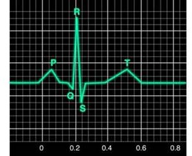Educational illustration of electrocardiogram electrodes and a rhythm tracing
