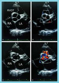 Educational illustration of an echocardiogram ultrasound examination