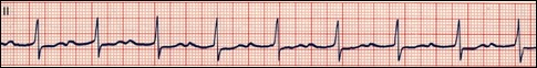 Simple diagram of delayed or blocked conduction from the atria to the ventricles