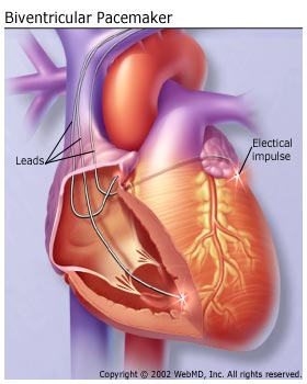 Educational illustration of a pacemaker pulse generator and leads