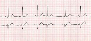 Educational illustration of premature atrial contractions on a rhythm strip