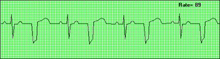 Example tracing showing premature ventricular contractions