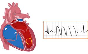 Illustration of disorganized ventricular fibrillation activity