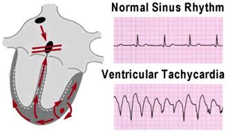 Illustration of a rapid ventricular tachycardia rhythm